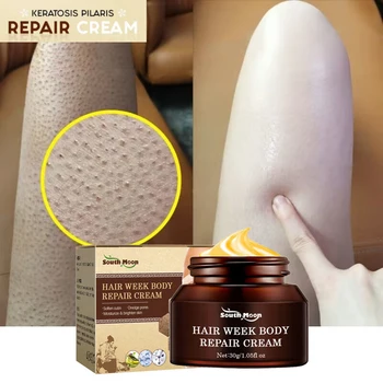 Keratóza Pilaris Repair Treatment Cream Zúčtovania Akné, Škvrny Odstránenie Kuracie Kože, Husia Koža, Deep Moisturizing Hladké Starostlivosť O Pleť